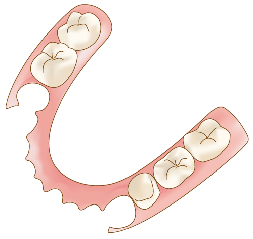 バネのない奥歯の部分入れ歯（ノンクラスプデンチャー）