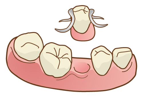 部分入れ歯